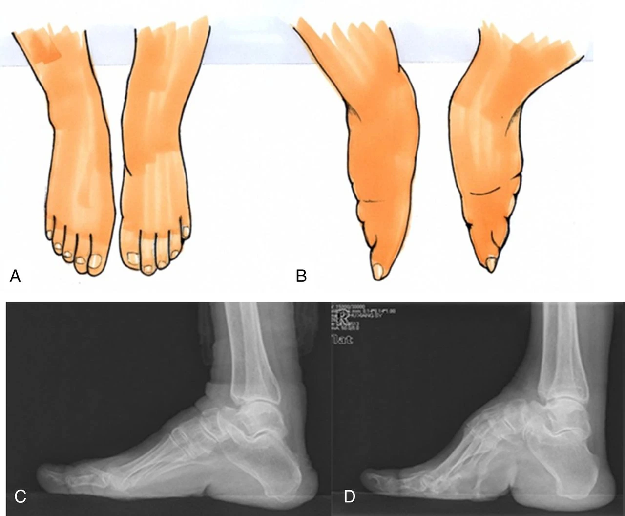 Footbinding - The High Price of Beauty