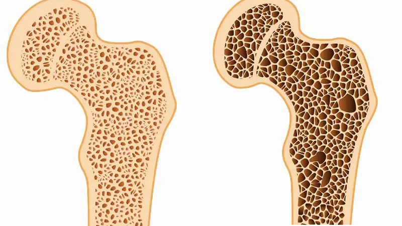 Guarding Against Osteoporosis: A Path to Stronger Bones